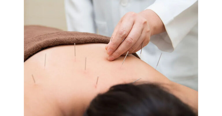 The Ultimate Guide to the Best TCM Acupuncture Practices for Optimal Health