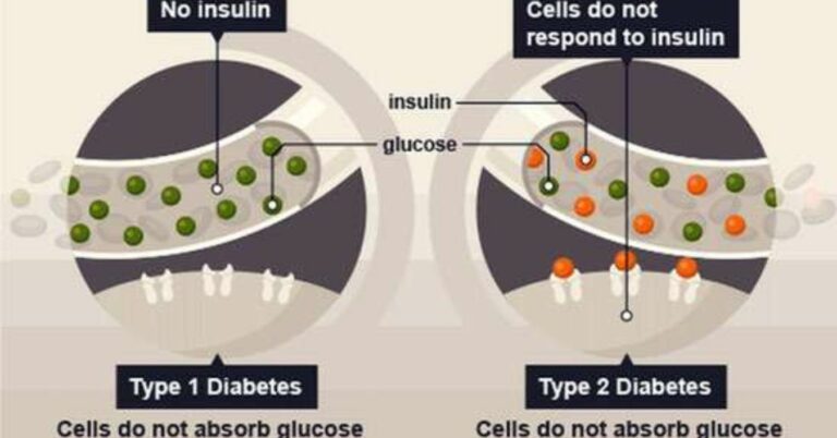Type 2 Diabetes Stem Cell Treatment India: A Breakthrough in Modern Medicine
